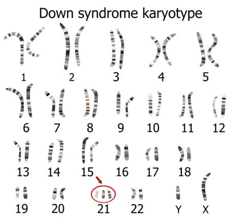 ダウン症の原因は減数分裂時の染色体のわけ間違い
