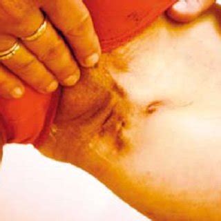 (PDF) Adalimumab Treatment for Hidradenitis Suppurativa ...
