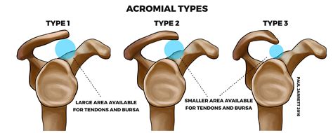 Types Of Acromion Shapes