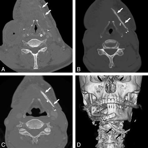 Axial Contrast Enhanced Neck Ct Scans And 3d Reformat Performed In A