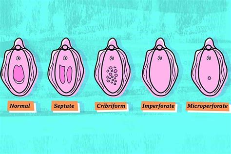 Types Of Hymen That We Didn’t Know Existed