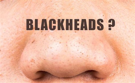 How To Get Rid Of Deep Blackheads And Clogged Pores Beauty And Skin Care