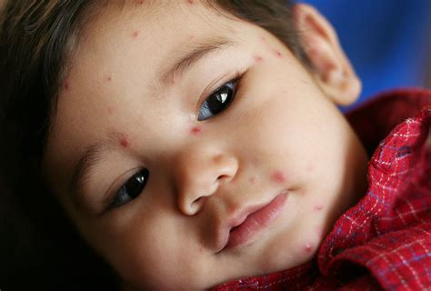 Hantavirus syndrome pulmonary droppings electron hantaviruses rodent virus carried microscopy micrograph transmission science nombre sin pixnio cause. Chickenpox (Varicella) | Disease of the Week | CDC