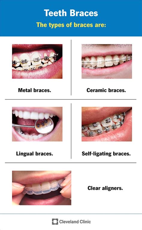 Braces Types And How They Work