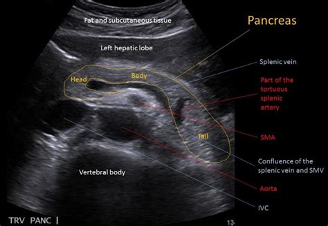 Windham was previously a surgical. Normal pancreas (ultrasound) | Radiology Case ...