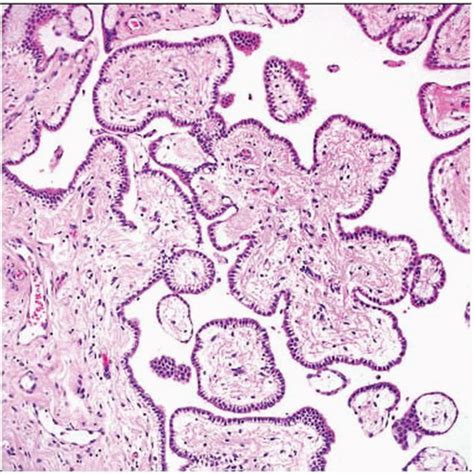 Serous borderline tumour of the ovary. Hematoxylin & eosin shows well-formed branching papillary ...