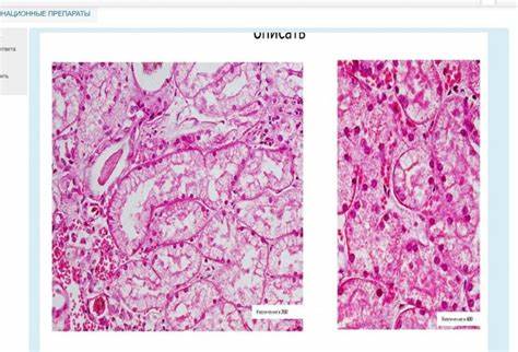 Диета при лимфоме не ходжкина Лимфоузел при лимфоме Ходжкина (№ 90) Лимфоузел при лимфоме Ходжкина (№ 90) Диета при лимфоме не ходжкина