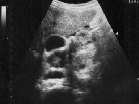 Abdominal Ultrasonography In Hivaids Patients In Southwestern Nigeria