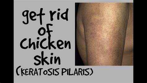 How To Get Rid Of Chicken Skin Keratosis Pilaris Dr Dray Youtube