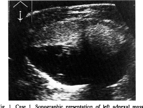 Figure 2 From Characteristic Fat Fluid Level At Ultrasonography Of