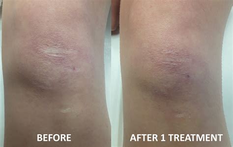 Scar Before And After 1 Treatment 1 Revive Laser And Skin Clinic