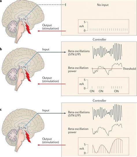 Deep Brain Stimulation Dbs Treat Parkinson Disease Free Consultation
