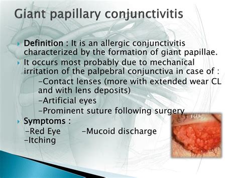 Ppt Allergic Conjunctivitis Powerpoint Presentation Free Download