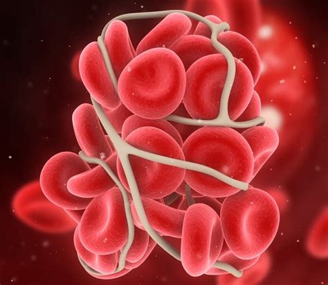 Symptoms of blood clots in lung symptoms of a pulmonary embolism depend on the size of the clot and where it lodges in the lung. Deep vein thrombosis | Australia| PDF | PPT| Case Reports | Symptoms | Treatment
