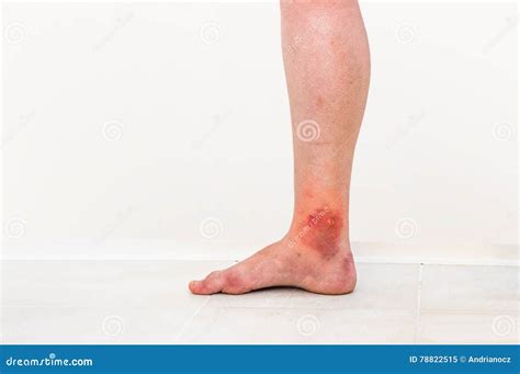 Red Rash On Leg Of Patient Who Was Bitten By An Insect Stock Image