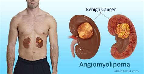 Changes In Kidney Structure Caused By Angiomyolipoma Kidney Tumor