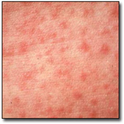 An unusual rash in a child. Urticaria natna lo lanchhuah dan: Images - Frompo