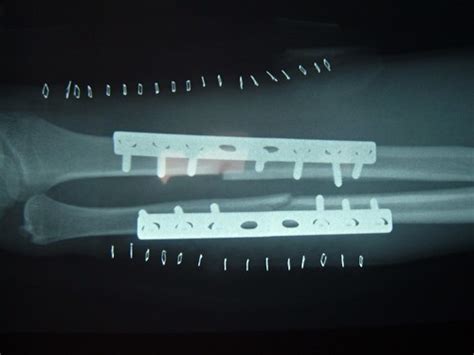 X Ray Metal Plates To Hold Ulna And Radius Together June Flickr
