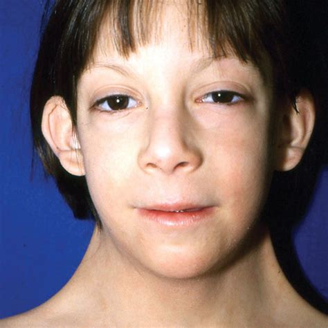 A 6 Year Old Girl With Pterygium Colli Associated With Turner Syndrome
