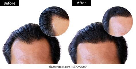 Before After Bald Head Man Stock Photo 1370975654 Shutterstock