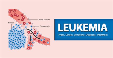 Over 40,000 people are diagnosed with a blood cancer each year in the uk, and over 250,000 people are currently living with blood cancer. Leukaemia - Types, Causes, Symptoms, Diagnosis, Treatment