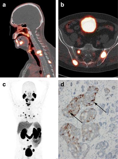 68ga Psma Pet Ct Imaging Of Metastatic Adenoid Cystic Carcinoma