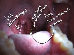 Is it possible for a pill to get stuck in your throat? fish bone stuck in throat ก้างปลาติดคอ: Effective home ...