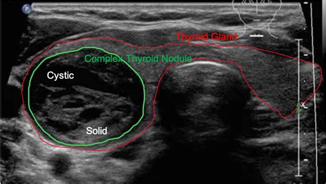 Thyroid Ultrasound Trilogy Iii How Does Your Thyroid Look Like On