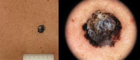 Melanoma Maligno O Benigno Sintomi E Immagini Del Tumore Della Pelle