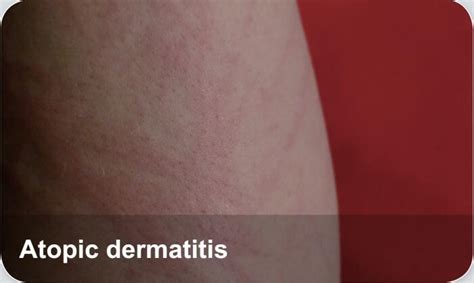 Dermatology Diseases Atopic Dermatitis Elabscience