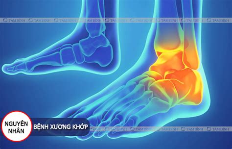 Viêm khớp cổ chân Nguyên nhân triệu chứng và cách điều trị