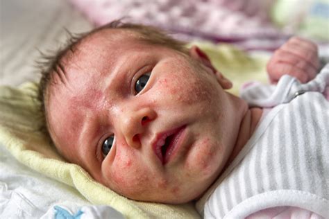 Macam Macam Penyakit Kulit Pada Bayi Dan Penanganannya Bukareview