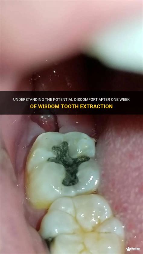 Understanding The Potential Discomfort After One Week Of Wisdom Tooth