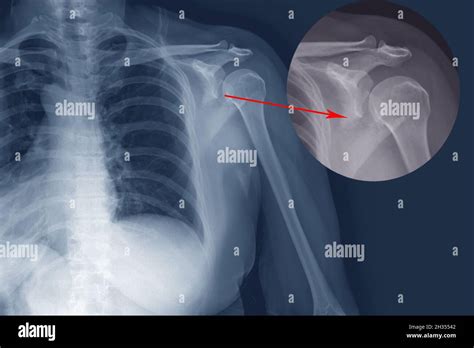 X Ray Shoulder Fracture Posterior Half Of Glenoid With Posterior