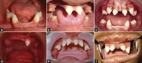 Intra Oral Photographs Of Patients With Ectodermal Dysplasia Note Download Scientific Diagram
