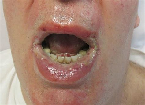 Reactive Infectious Mucocutaneous Eruption Secondary To Covid 19 The Bmj