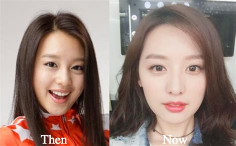 Kim Ji Won Plastic Surgery Before And After Photos Latest Plastic