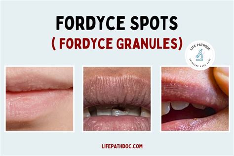 Fordyce Spots Identification Causes And Treatment