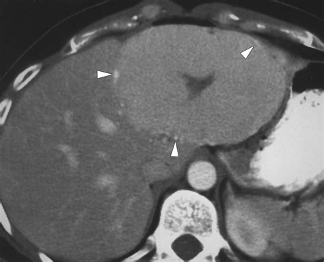 Ct Of Focal Nodular Hyperplasia Of The Liver Ajr
