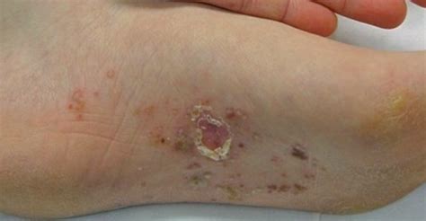 Dyshidrotic Eczema Pictures Treatment Causes Contagious Symptoms