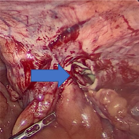 Cureus Amyands Hernia Perforated Appendix In An Incarcerated