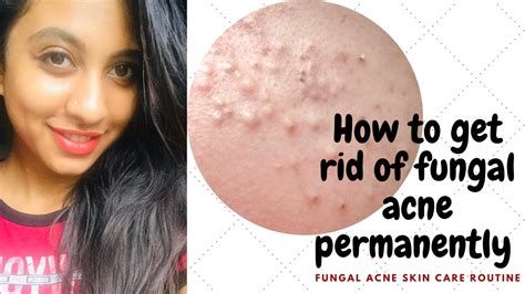 How To Cure Fungal Acne Permanently Tiny Little Bumps On Face