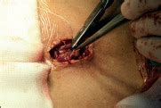 Is Complete Mesocolic Excision Superior To Conventional Colectomy For Colon Cancer The Lancet