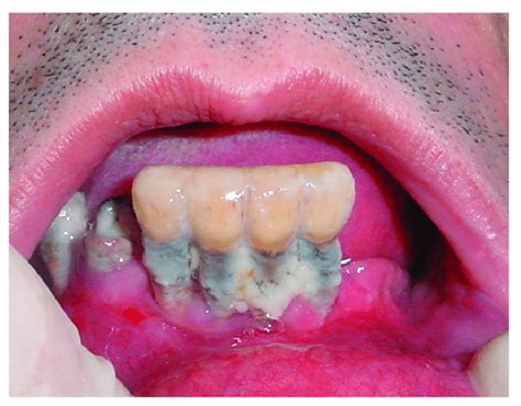 Severe Periodontal Disease And Partial Edentulism In Subjects Suffering