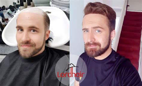 Every Day Is A New Hair Day At Lordhair Here Is Before And After Pic