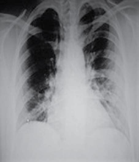 Normal Erect Chest X Ray Showing No Air Under The Diaphragm Download
