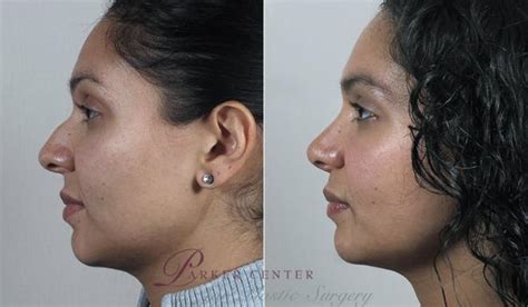 Rhinoplasty Before And After Pictures Case 205 Paramus Nj Parker