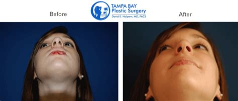 Reconstructive Surgery Procedures At Tampa Bay Plastic Surgery