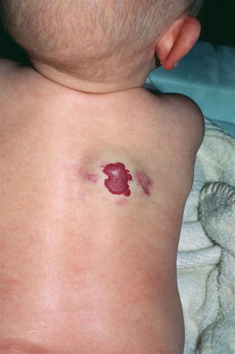 Strawberry Birthmark Photograph By Mike Devlinscience Photo Library