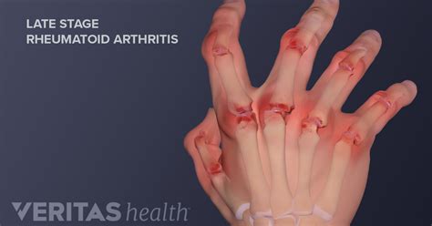 Treatments For Rheumatoid Arthritis In Hands